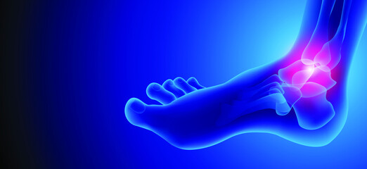Illustration of Arthritis ankle joint . Rheumatoid arthritis.  Human bone anatomy flat vector illustration on a blue technology background. 3d rendered medically accurate illustration.