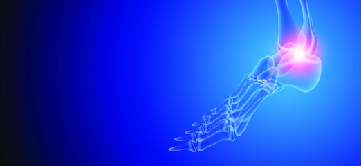 Illustration of Arthritis ankle joint . Rheumatoid arthritis.  Human bone anatomy flat vector illustration on a blue technology background. 3d rendered medically accurate illustration. - obrazy, fototapety, plakaty