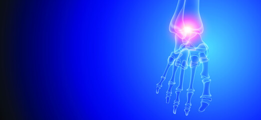 Illustration of Arthritis ankle joint . Rheumatoid arthritis.  Human bone anatomy flat vector illustration on a blue technology background. 3d rendered medically accurate illustration.