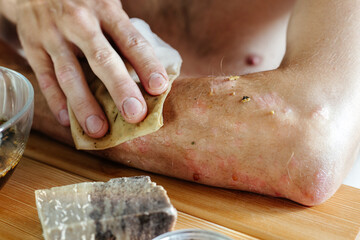 Man with skin disease rubbing hand with herbal decoction 