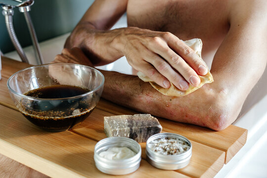 Man with skin disease applying compress on hand