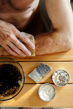 Man with psoriasis using phytotherapy