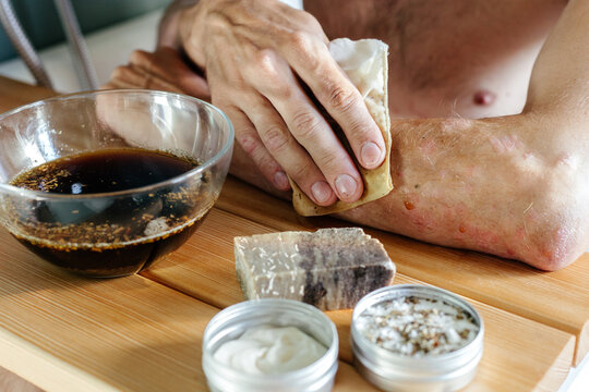 Crop male with psoriasis caring for skin
