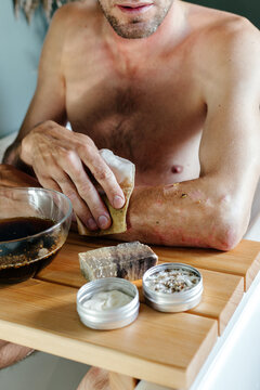Man with psoriasis applying herbal compress on hand