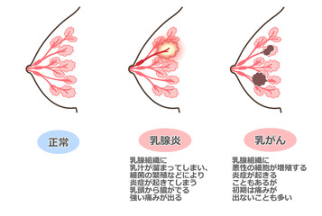胸の病気のイラスト