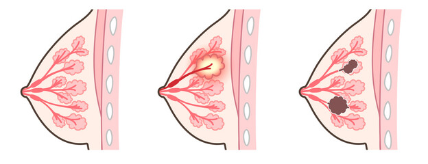 乳腺炎のイラスト