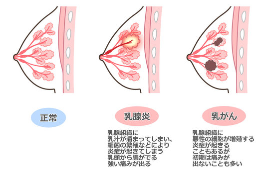 45 Best 乳腺症 Images Stock Photos Vectors Adobe Stock