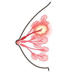 乳腺炎のイラスト