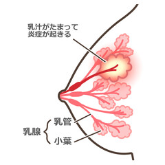 Obraz premium 乳腺炎のイラスト 説明付
