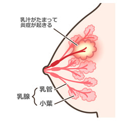 乳腺炎のイラスト　説明付