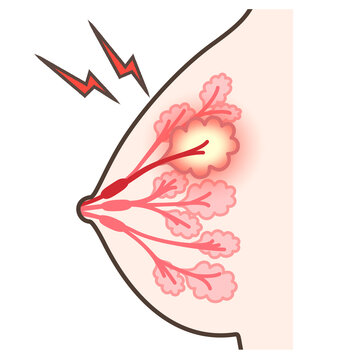 45 Best 乳腺症 Images Stock Photos Vectors Adobe Stock