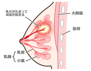 乳腺炎のイラスト　説明付