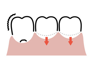 歯茎下がり／抜けそうな歯