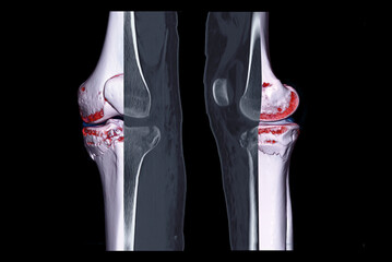 Compare of CT knee joint 3D rendering image and CT knee sagittal view and CT knee 2D Sagittal view...
