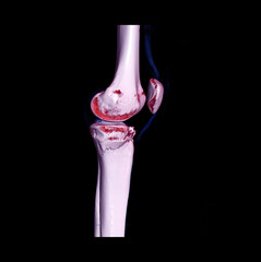CT knee joint 3D rendering image  showing fracture tibia bone