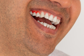 Close up photo of brown skinned young adult man with gum inflammation. Teeth care concept.