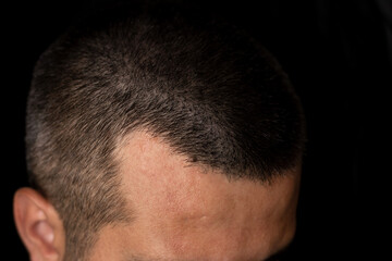 Obraz premium Close up photo of a man with hair loss