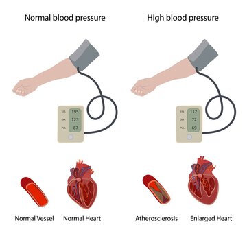 Hypertensive heart disease, illustration