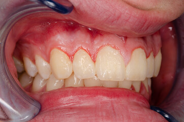gingivitis and dental plaque, upper right front - obrazy, fototapety, plakaty