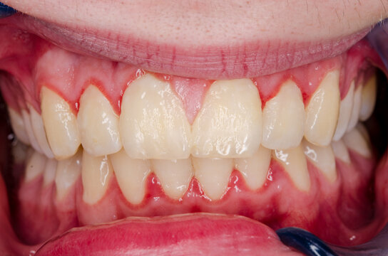 gingivitis and dental plaque, upper incisors