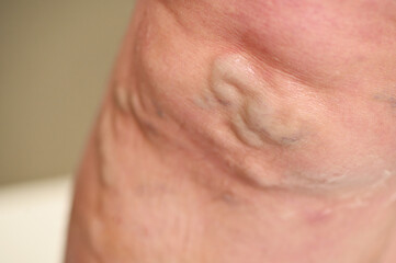 Naklejka premium varicose veins close-up on the patient's leg. Prevention of thrombosis