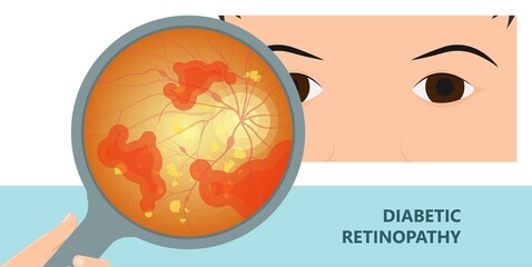 Diabetic retinopathy fundus age eye blood vessels vision Blurred loss exam pregnant retinal macula Blurry laser surgery