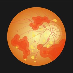 Diabetic retinopathy fundus age eye blood vessels vision Blurred loss exam pregnant retinal macula Blurry laser surgery