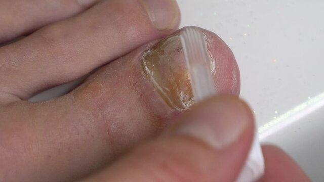 Mycosis On Big Toe Nail Treatment With Medicated Antifungal Nail Polish. close up