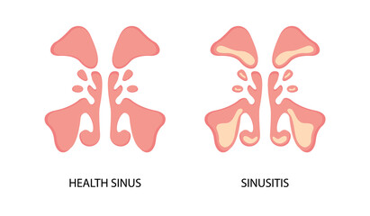 Healthy sinus and sinusitis flat image. Infection, inflammation, nasal diseases. Can be used for topics like health, diagnosis, anatomy