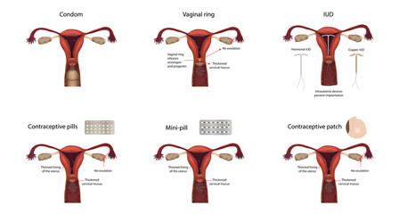 Contraception methods. IUD, contraceptive patch, pills, mini-pill, condom, vaginal ring. Vector medical illustration.