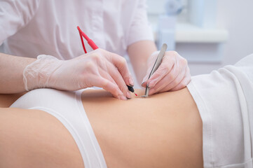 Woman on electro epilation on her tummy. Permanent hardware removal of unwanted abdominal hair.