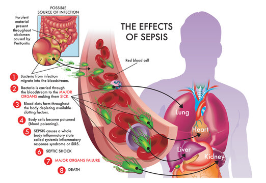 Medical illustration of effects of sepsis.