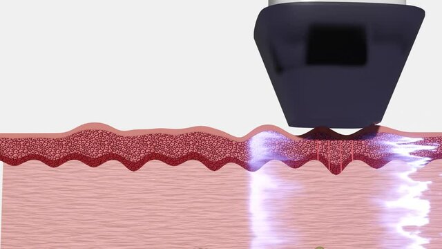 Faltenbehandlung/Faltenentfernung mit dem Laser