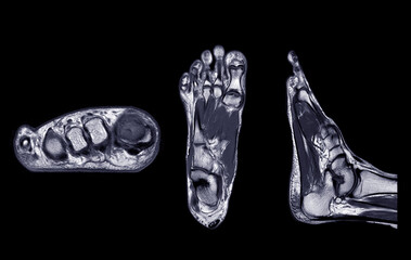 Manetic resonance imaging of foot or MRI FOOT PDW axial, Coronal and sagittal view for diagnostic...