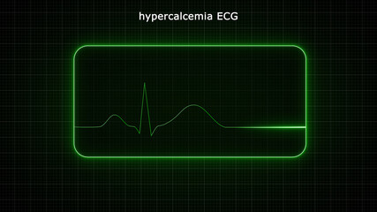  The main ECG abnormality seen with hypercalcaemia is shortening of the QT interval ·
