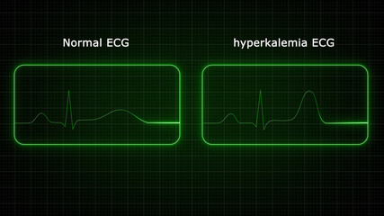 Hypokalemia is when blood's potassium levels are too low. Potassium is an important electrolyte for nerve and muscle cell functioning, especially for muscle cells in the heart.