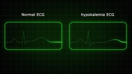 Hypokalemia is when blood's potassium levels are too low. Potassium is an important electrolyte for nerve and muscle cell functioning, especially for muscle cells in the heart.