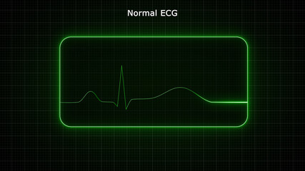 An electrocardiogram (ECG) is a simple test that can be used to check your heart's rhythm and electrical activity. Sensors attached to the skin are used to detect the electrical signals produced.