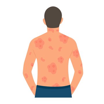 Dermatological Skin Disease, Psoriasis.Allergic Itching, Skin Inflammation, Redness And Irritation.Guttate Psoriasis.Skin Problems.isolated, Vector.