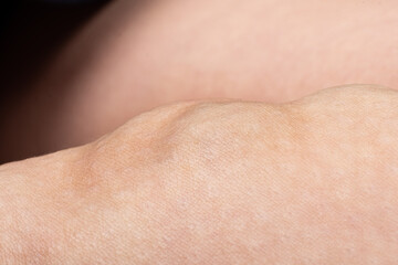 disease phlebeurysm in leg, varicose veins