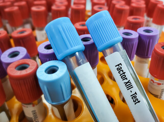 Blood sample for Factor XIII or fibrin stabilizing factor test, diagnosis of coagulation disorder....