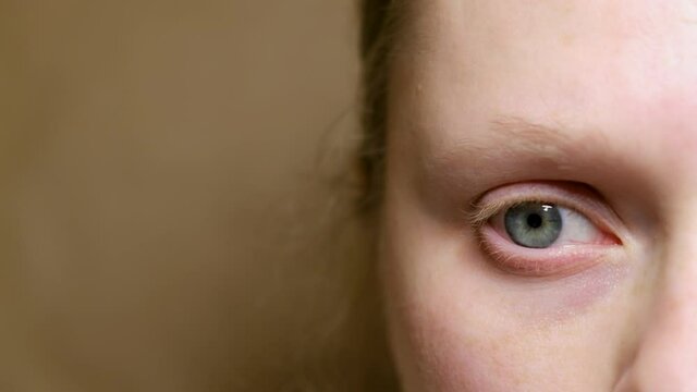 close-up woman looking at the camera, horizontal nystagmus, woman with uncontrolled rhythmic movements of the eyeballs. eyes health concept