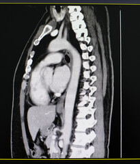 CT scan (computed tomography) of chest and abdominal organs.