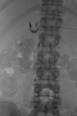 X-ray was perform inferior vena cava (IVC) filter placement, IVC filter for trapping large clots