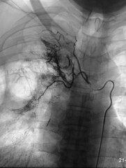 Pulmonary angiography with contrast injected into embolization of right bronchial artery