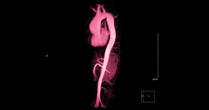 mra whole aorta red color turn around on black background.