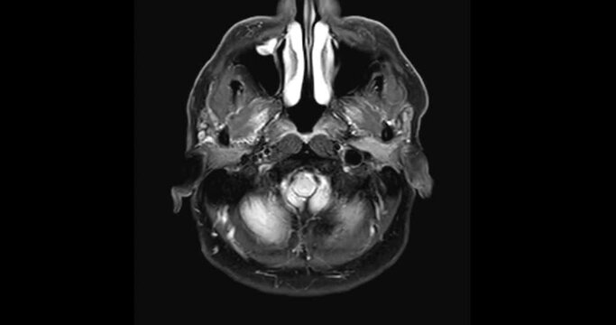 Mri brain axial t2w flair fat suppression for diagnonsis brain stroke disease.