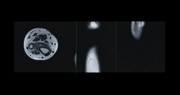 MRI wrist joint Axial , coronal and sagittal viewPDW For diagnosis rheumatoid arthritis.