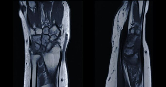MRI wrist joint coronal and sagittal view PDW For diagnosis rheumatoid arthritis.
