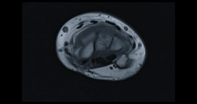 MRI hand coronal t1w for diagnosis bone arthritis and rheumatoid.